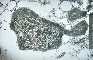 M,15y. | Wilson disease - megamitochondria M,15y. | Wilson disease - megamitochondria